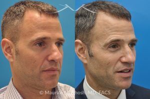 Photo of a patient before and after a procedure. Rhinoplasty for Twisted Nose - pre- and post-operative.