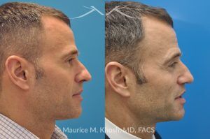 Photo of a patient before and after a procedure. Rhinoplasty for Twisted Nose - pre- and post-operative.