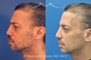 Photo of a patient before and after a procedure. Botox, Cheek Filler, and Upper Blepharoplasty - 55-year-old gentleman treated with Botox Cosmetic to smooth forehead wrinkles and smile lines, and Voluma cheek filler to restore mid-face volume. Upper blepharoplasty was also performed to remove sagging upper eyelids, enhancing overall facial rejuvenation.