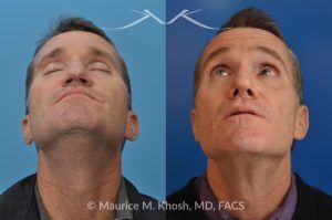 Photo of a patient before and after a procedure. Nasal Valve Repair with Rib Cartilage Graft - pre- and post-operative.