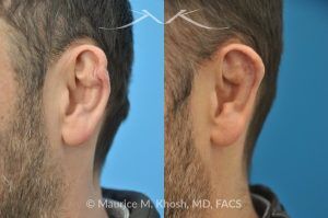 Photo of a patient before and after a procedure. Cauliflower Ear Deformity Repair - before-and-after composite photo.