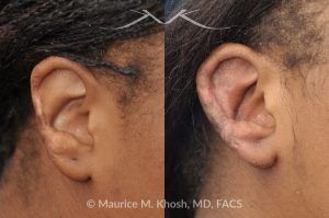 Photo of a patient before and after a procedure. Ear Reconstruction To Repair The Helical Rim After Traumatic Injury - before-and-after composite photo.
