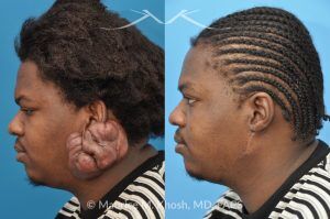 Photo of a patient before and after a procedure. Keloid Ear - before and after treatment results.