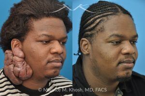 Photo of a patient before and after a procedure. Keloid Ear - before and after treatment results.