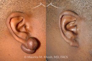 Photo of a patient before and after a procedure. Keloid Earlobe - before and after treatment results.