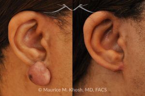 Photo of a patient before and after a procedure. Keloid Earlobe - before and after treatment results.