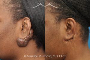 Photo of a patient before and after a procedure. Keloid Earlobe - before and after treatment results.
