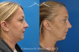 Photo of a patient before and after a procedure. Kybella treatment for double chin and neck fat - A 52 year old looking for non surgical treatment of her excess neck fat and double chin. She did not wish to have neck liposuction and preferred Kybella injections in New York City to dissolve the neck fat.