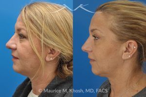 Photo of a patient before and after a procedure. Kybella treatment for double chin and neck fat - A 52 year old looking for non surgical treatment of her excess neck fat and double chin. She did not wish to have neck liposuction and preferred Kybella injections in New York City to dissolve the neck fat.