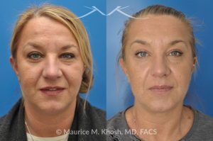 Photo of a patient before and after a procedure. Kybella treatment for double chin and neck fat - A 52 year old looking for non surgical treatment of her excess neck fat and double chin. She did not wish to have neck liposuction and preferred Kybella injections in New York City to dissolve the neck fat.