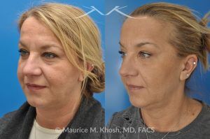 Photo of a patient before and after a procedure. Kybella treatment for double chin and neck fat - A 52 year old looking for non surgical treatment of her excess neck fat and double chin. She did not wish to have neck liposuction and preferred Kybella injections in New York City to dissolve the neck fat.