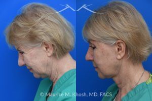 Photo of a patient before and after a procedure. Deep Plane Facelift with Brow and Eyelid Rejuvenation - Our delightful patient was interested in overall facial rejuvenation. She underwent lower blepharoplasty with orbital fat repositioning, temporal brow lift, and a deep plane facelift. She is ecstatic with her surgical results.