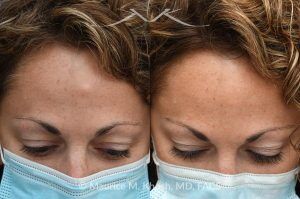 Photo of a patient before and after a procedure. Forehead Osteoma Removal with Hidden Scar - This 43 year old had been bothered by the hard bony bump in the middle of her forehead. She travelled from out of town, for forehead osteoma removal in New York. She could not be more satisfied. The incision in the hairline is invisible six months after surgery. 