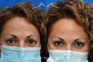 Photo of a patient before and after a procedure. Forehead Osteoma Removal with Hidden Scar - This 43 year old had been bothered by the hard bony bump in the middle of her forehead. She travelled from out of town, for forehead osteoma removal in New York. She could not be more satisfied. The incision in the hairline is invisible six months after surgery. 