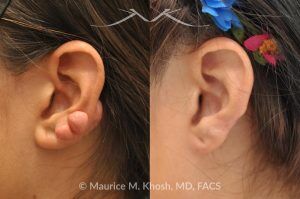 Photo of a patient before and after a procedure. Keloid Ear - before and after treatment results.