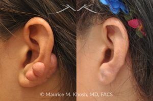 Photo of a patient before and after a procedure. Keloid Ear - before and after treatment results.
