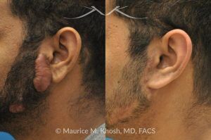 Photo of a patient before and after a procedure. Keloid - before and after treatment results.