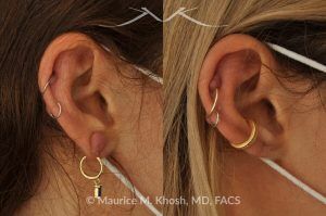 Photo of a patient before and after a procedure. Earlobe Keloid Removal with Minimal Scarring - This 40-year-old had developed a keloid in the right earlobe, after a piercing. The keloid was removed, leaving a very fine scar in the earlobe.