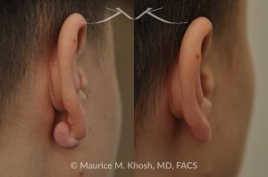 Photo of a patient before and after a procedure. Earlobe Keloid Removal (Posterior Side) - before and after treatment results.