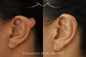 Photo of a patient before and after a procedure. Keloid scar removal from the upper part of the ear (auricle) - before and after treatment results.