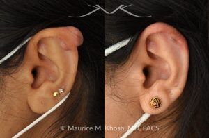 Photo of a patient before and after a procedure. Keloid After Ear Piercing - This delightful patient had formed a keloid after an ear piercing in the upper part of her ear. Keloid removal allowed restoration of a normal appearing ear. She is ecstatic with her results.