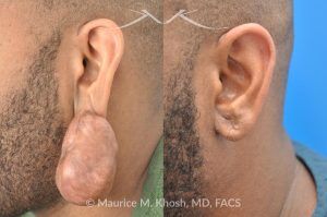 Photo of a patient before and after a procedure. Large Keloid of Ear - before and after treatment results.
