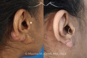 Photo of a patient before and after a procedure. Large Dumble Shaped Keloid of Right Ear - before and after treatment results.