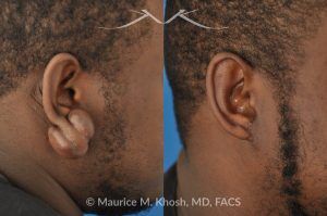 Photo of a patient before and after a procedure. Large Earlobe Keloid Removal - before and after treatment results.