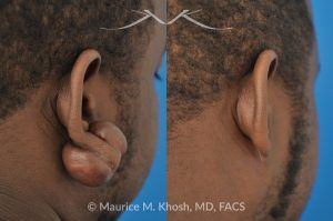 Photo of a patient before and after a procedure. Large Earlobe Keloid Removal - before and after treatment results.