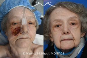 Photo of a patient before and after a procedure. Mohs skin reconstruction of the cheek - A very large defect on the right medial cheek, resulting from a Mohs procedure, was successfully repaired using a cervico-facial advancement rotation flap. This technique allowed for the restoration of both the aesthetic and functional integrity of the cheek area, resulting in a natural and smooth appearance.