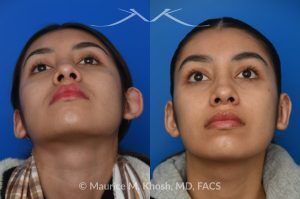 Photo of a patient before and after a procedure. Unilateral Otoplasty for Correction of Left Ear Deformity - This young patient had a left ear deformity with over-projection of the upper aspect of the ear due to poor formation of the helical fold of the ear. Unilateral otoplasty was performed in the office under local anesthesia. Mustarde suture technique was used to create a properly contoured helical fold. 