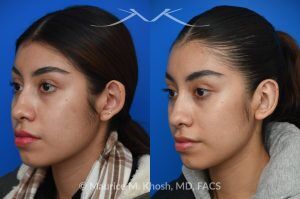 Photo of a patient before and after a procedure. Unilateral Otoplasty for Correction of Left Ear Deformity - This young patient had a left ear deformity with over-projection of the upper aspect of the ear due to poor formation of the helical fold of the ear. Unilateral otoplasty was performed in the office under local anesthesia. Mustarde suture technique was used to create a properly contoured helical fold. 