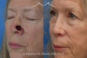 Photo of a patient before and after a procedure. Mohs repair of nose - Mohs excision of a basal cell carcinoma resulted in this large defect in the left lower nose. Initially a full thickness skin graft was used to resurface the nose. Following the skin graft, there was some contracture of the internal nose which compromised the patient's breathing. This problem was addressed with a composite (skin and cartilage graft) from the ear to inside of the nose. 