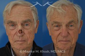Photo of a patient before and after a procedure. Mohs repair of nose skin cancer with forehead flap - before and after photos.