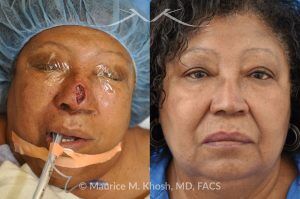 Photo of a patient before and after a procedure. Nasal reconstruction with bilateral midline advancement flaps - before and after photos.