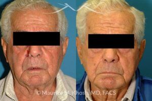 Photo of a patient before and after a procedure. Nose alar Moh's skin cancer reconstruction - before and after photos.