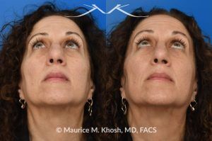 Photo of a patient before and after a procedure. Nose fracture, dorsal widening and deviaiton to the left side. - photo before and after repair.