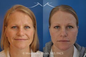 Photo of a patient before and after a procedure. Osteoma of Left Forehead Removed - before-and-after composite photo.