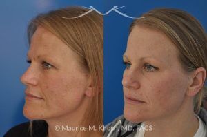 Photo of a patient before and after a procedure. Osteoma of Left Forehead Removed - before-and-after composite photo.