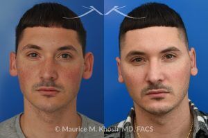 Photo of a patient before and after a procedure. Otoplasty to Correct Prominent Ears and Reduce Left Ear Size - This 26 year-old requested consultation regarding earpinnig and reducing the size of the left ear. He found both ears to be sticking out too far, and noted the left ear to be larger than the right side. Otopalsty was performed under local anesthesia in our Manhattan office. Both ears were pushed closer to the scalp. The left ear was shortened.