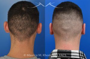 Photo of a patient before and after a procedure. Otoplasty to Correct Prominent Ears and Reduce Left Ear Size - This 26 year-old requested consultation regarding earpinnig and reducing the size of the left ear. He found both ears to be sticking out too far, and noted the left ear to be larger than the right side. Otopalsty was performed under local anesthesia in our Manhattan office. Both ears were pushed closer to the scalp. The left ear was shortened.