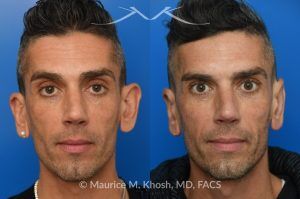 Photo of a patient before and after a procedure. Ear Pinning with Mustarde Sutures - This pleasant patient presented with interest in otoplasty in Manhattan to address prominent ears and reduce auricular projection. The procedure for ear pinning involved conchal setback and Mustarde sutures.