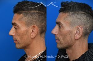 Photo of a patient before and after a procedure. Ear Pinning with Mustarde Sutures - This pleasant patient presented with interest in otoplasty in Manhattan to address prominent ears and reduce auricular projection. The procedure for ear pinning involved conchal setback and Mustarde sutures.