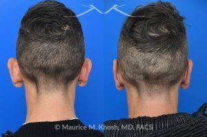 Photo of a patient before and after a procedure. Ear Pinning with Mustarde Sutures - This pleasant patient presented with interest in otoplasty in Manhattan to address prominent ears and reduce auricular projection. The procedure for ear pinning involved conchal setback and Mustarde sutures.