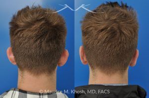 Photo of a patient before and after a procedure. Otoplasty - Ear pinning to push back excessively projected ears and flatten ears.