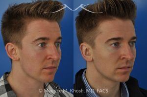 Photo of a patient before and after a procedure. Otoplasty - Ear pinning to push back excessively projected ears and flatten ears.