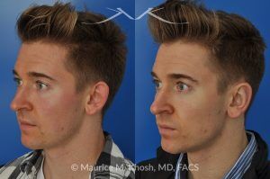 Photo of a patient before and after a procedure. Otoplasty - Ear pinning to push back excessively projected ears and flatten ears.