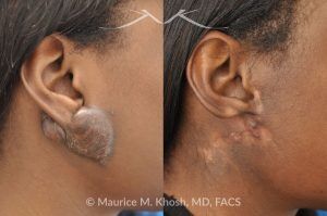Photo of a patient before and after a procedure. Recurrent Earlobe Keloid Treated with Surgery & Radiation - This 24 year old had a keloid of the right which had been excised three times in the past. Each time the keloid recurred and became larger. She was treated with surgical excision followed by radiation therapy. The pictures depict a one year post operative result.