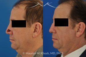 Photo of a patient before and after a procedure. Repair of Moh's defect of the lower nose with local skin flap - before and after photos.