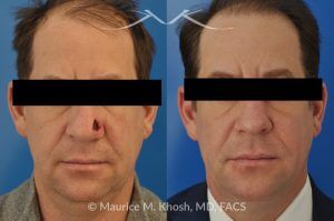 Photo of a patient before and after a procedure. Repair of Moh's defect of the lower nose with local skin flap - before and after photos.